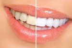 Les effets secondaires du blanchiment dentaire