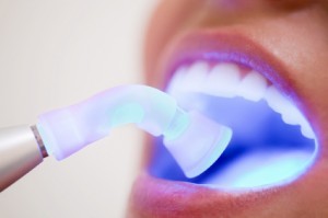 Le blanchiment des dents par laser Blanchiment des dents