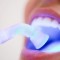Le blanchiment des dents par laser